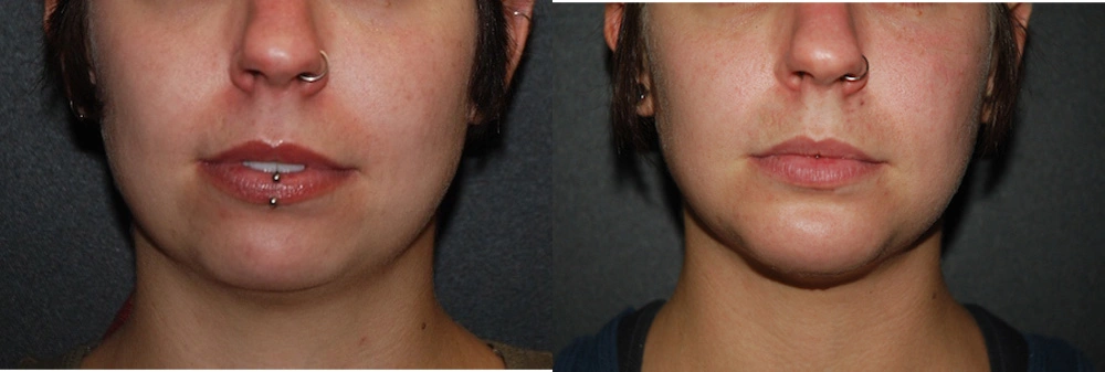 Real Patient Results in Newport Beach, CA. Preformed by Semira Bayait, MD, FACS.