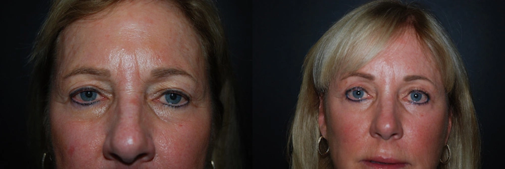 Real Patient Results in Newport Beach, CA. Preformed by Semira Bayait, MD, FACS.