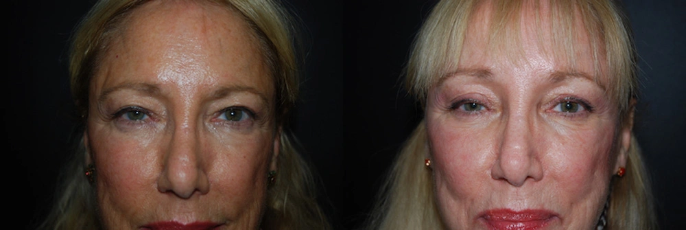 Real Patient Results in Newport Beach, CA. Preformed by Semira Bayait, MD, FACS.