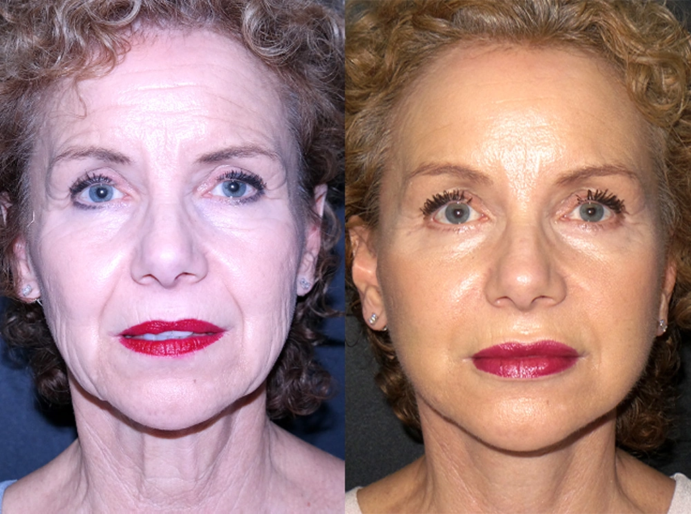 Real Patient Results in Newport Beach, CA. Preformed by Semira Bayait, MD, FACS.
