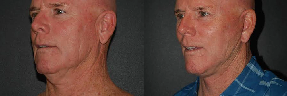 Real Patient Results in Newport Beach, CA. Preformed by Semira Bayait, MD, FACS.