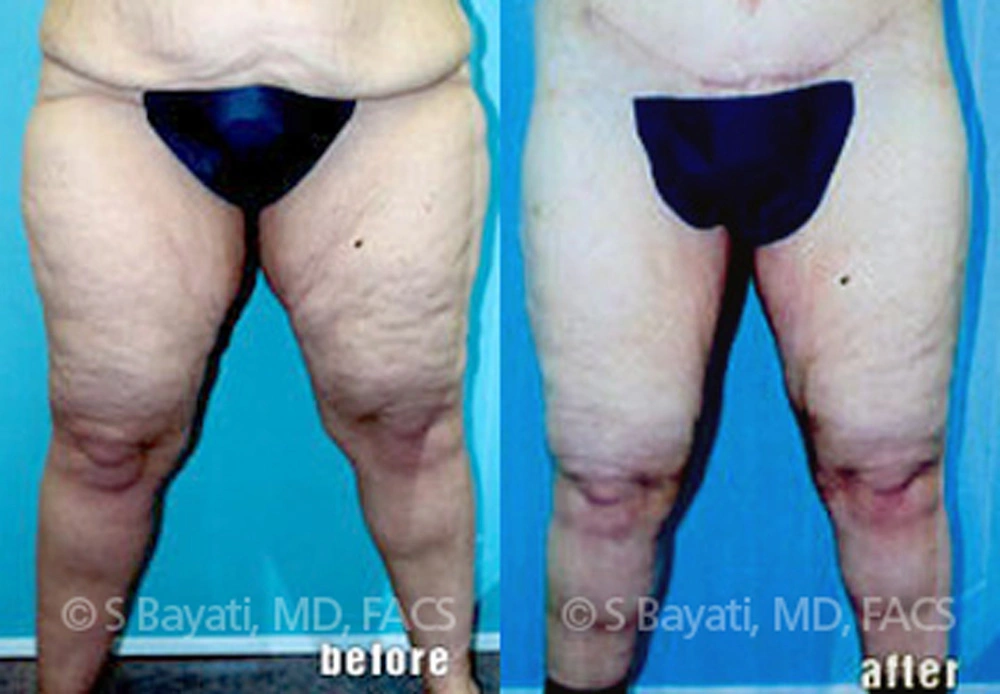 Real Patient Results in Newport Beach, CA. Preformed by Semira Bayait, MD, FACS.