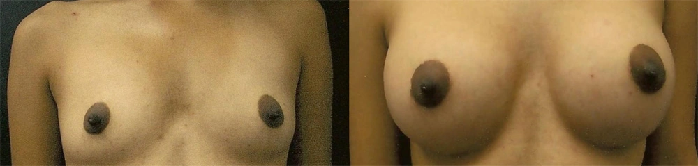 Real Patient Results in Newport Beach, CA. Preformed by Semira Bayait, MD, FACS.