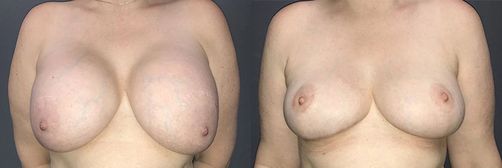 Real Patient Results in Newport Beach, CA. Preformed by Semira Bayait, MD, FACS.
