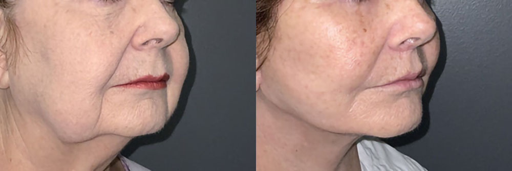 Real Patient Results in Newport Beach, CA. Preformed by Semira Bayait, MD, FACS.