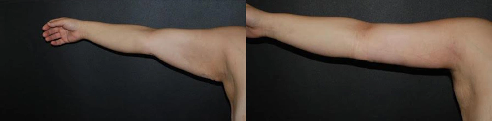 Real Patient Results in Newport Beach, CA. Preformed by Semira Bayait, MD, FACS.