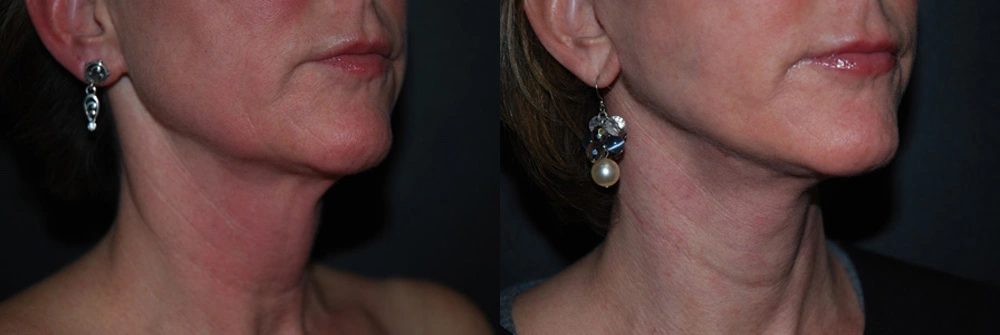 Real Patient Results in Newport Beach, CA. Preformed by Semira Bayait, MD, FACS.