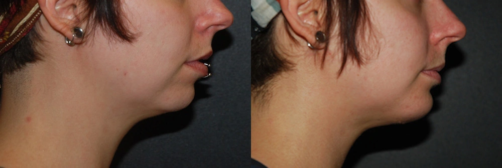Real Patient Results in Newport Beach, CA. Preformed by Semira Bayait, MD, FACS.