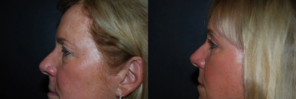 Real Patient Results in Newport Beach, CA. Preformed by Semira Bayait, MD, FACS.