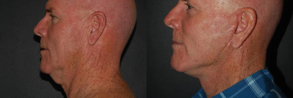 Real Patient Results in Newport Beach, CA. Preformed by Semira Bayait, MD, FACS.