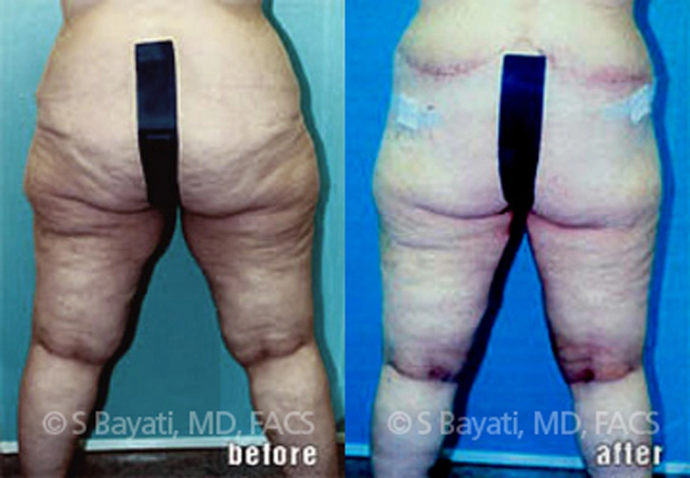 Real Patient Results in Newport Beach, CA. Preformed by Semira Bayait, MD, FACS.