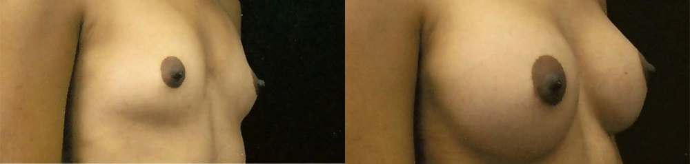 Real Patient Results in Newport Beach, CA. Preformed by Semira Bayait, MD, FACS.