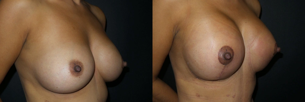 Real Patient Results in Newport Beach, CA. Preformed by Semira Bayait, MD, FACS.