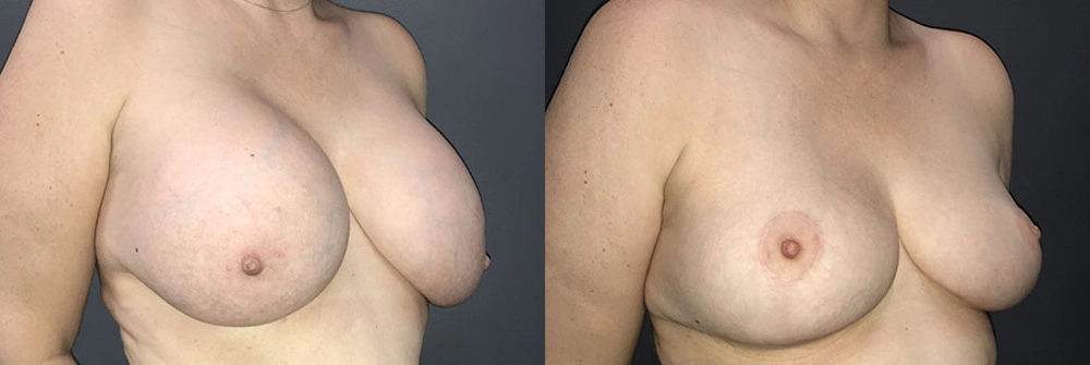 Real Patient Results in Newport Beach, CA. Preformed by Semira Bayait, MD, FACS.