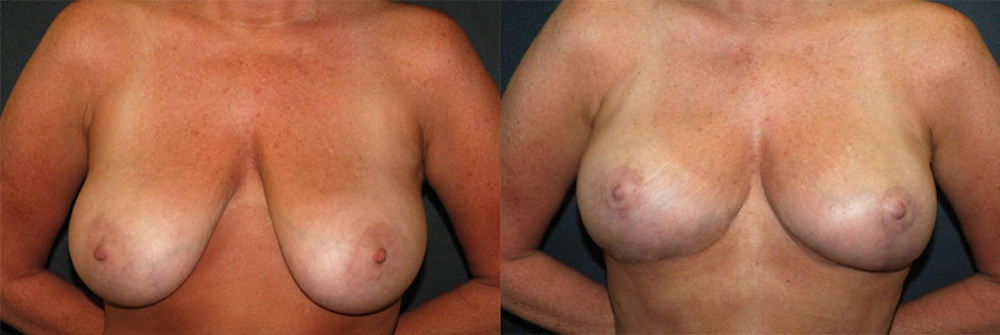 Real Patient Results in Newport Beach, CA. Preformed by Semira Bayait, MD, FACS.