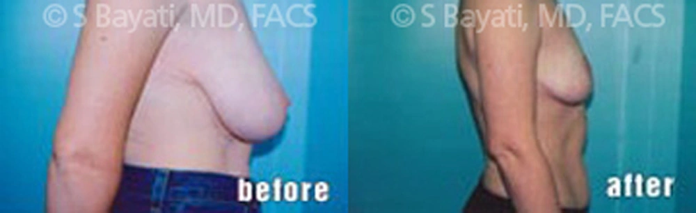 Real Patient Results in Newport Beach, CA. Preformed by Semira Bayait, MD, FACS.