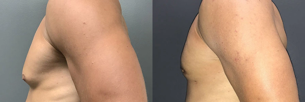 Real Patient Results in Newport Beach, CA. Preformed by Semira Bayait, MD, FACS.