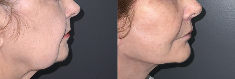 Real Patient Results in Newport Beach, CA. Preformed by Semira Bayait, MD, FACS.