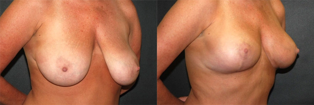 Real Patient Results in Newport Beach, CA. Preformed by Semira Bayait, MD, FACS.