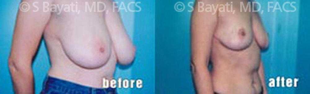 Real Patient Results in Newport Beach, CA. Preformed by Semira Bayait, MD, FACS.
