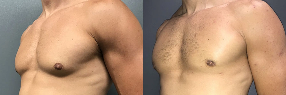 Real Patient Results in Newport Beach, CA. Preformed by Semira Bayait, MD, FACS.