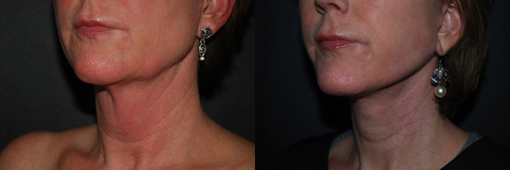 Real Patient Results in Newport Beach, CA. Preformed by Semira Bayait, MD, FACS.