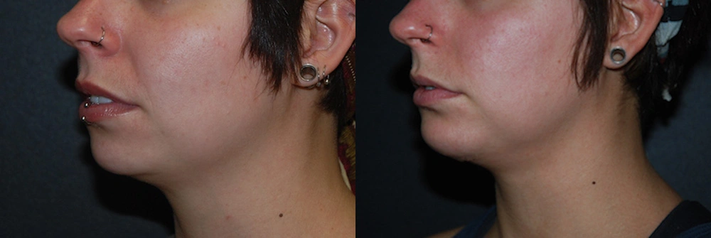 Real Patient Results in Newport Beach, CA. Preformed by Semira Bayait, MD, FACS.