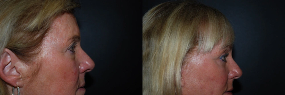 Real Patient Results in Newport Beach, CA. Preformed by Semira Bayait, MD, FACS.