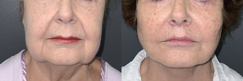 Real Patient Results in Newport Beach, CA. Preformed by Semira Bayait, MD, FACS.