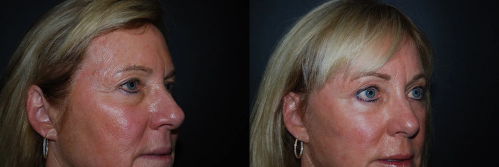 Real Patient Results in Newport Beach, CA. Preformed by Semira Bayait, MD, FACS.