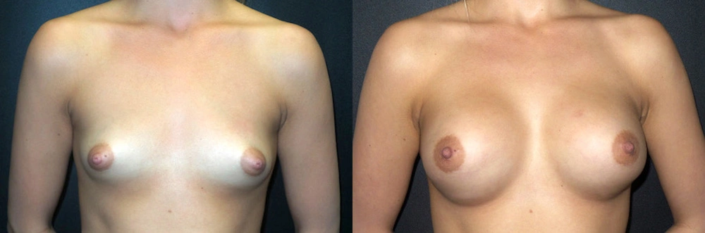 Real Patient Results in Newport Beach, CA. Preformed by Semira Bayait, MD, FACS.