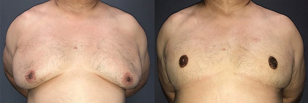 Real Patient Results in Newport Beach, CA. Preformed by Semira Bayait, MD, FACS.