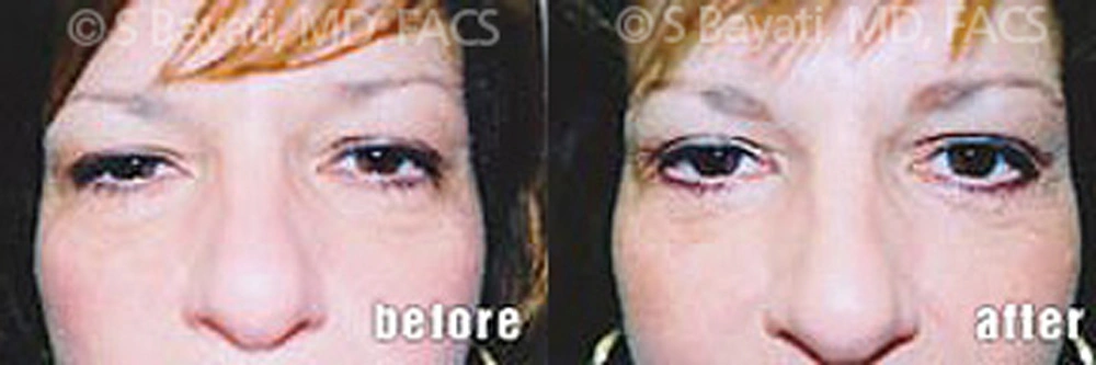 Real Patient Results in Newport Beach, CA. Preformed by Semira Bayait, MD, FACS.