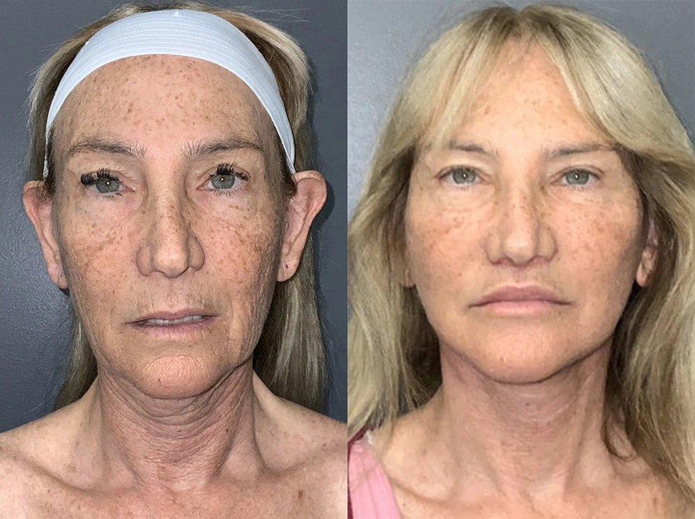 Real Patient Results in Newport Beach, CA. Preformed by Semira Bayait, MD, FACS.