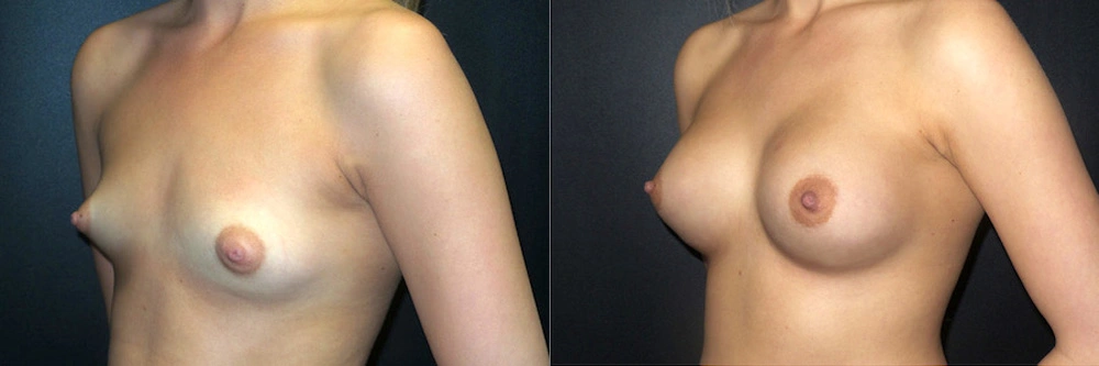 Real Patient Results in Newport Beach, CA. Preformed by Semira Bayait, MD, FACS.