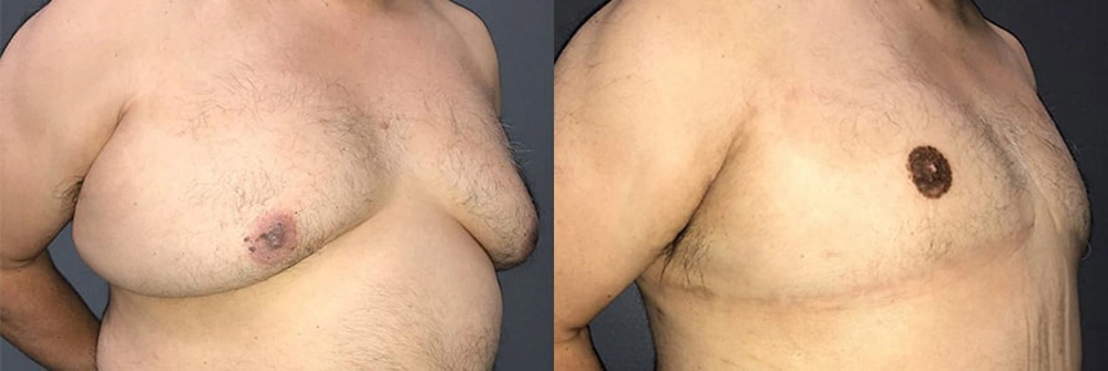 Real Patient Results in Newport Beach, CA. Preformed by Semira Bayait, MD, FACS.