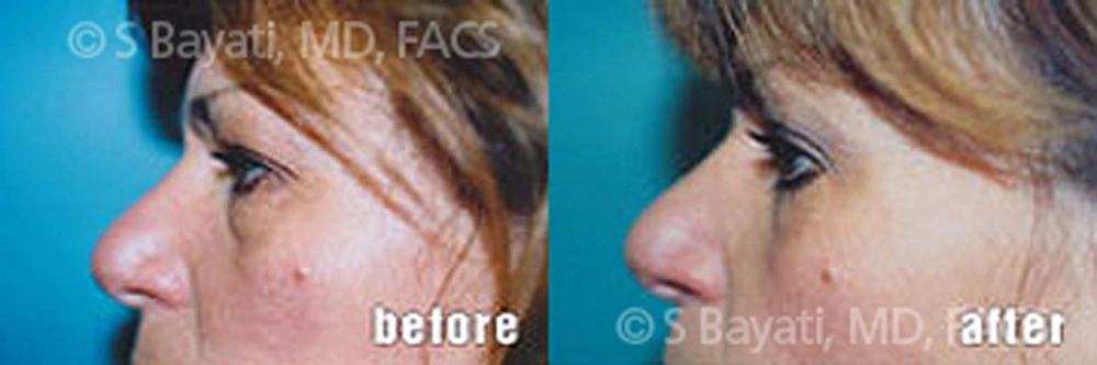 Real Patient Results in Newport Beach, CA. Preformed by Semira Bayait, MD, FACS.