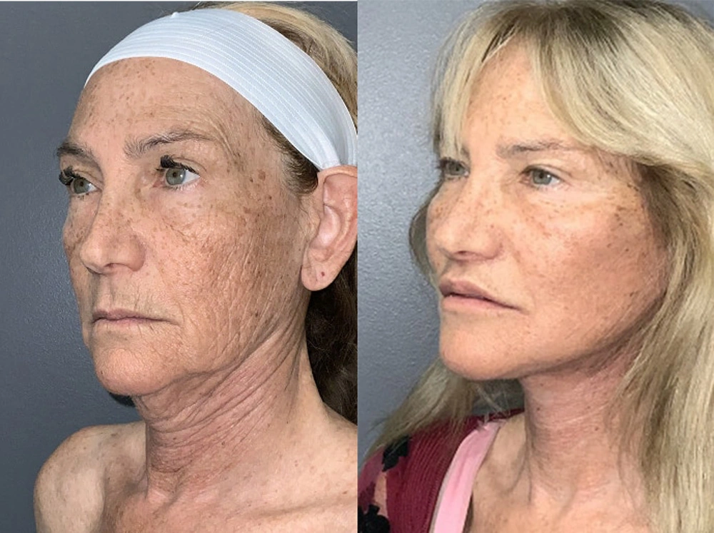 Real Patient Results in Newport Beach, CA. Preformed by Semira Bayait, MD, FACS.