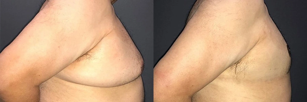Real Patient Results in Newport Beach, CA. Preformed by Semira Bayait, MD, FACS.
