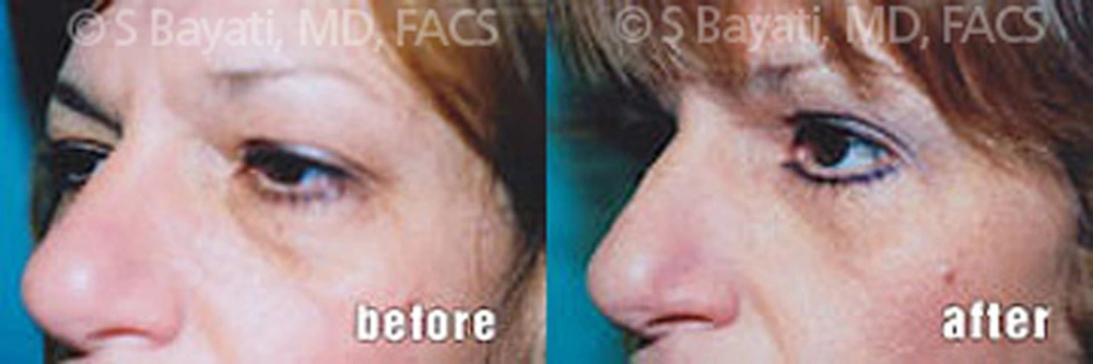 Real Patient Results in Newport Beach, CA. Preformed by Semira Bayait, MD, FACS.