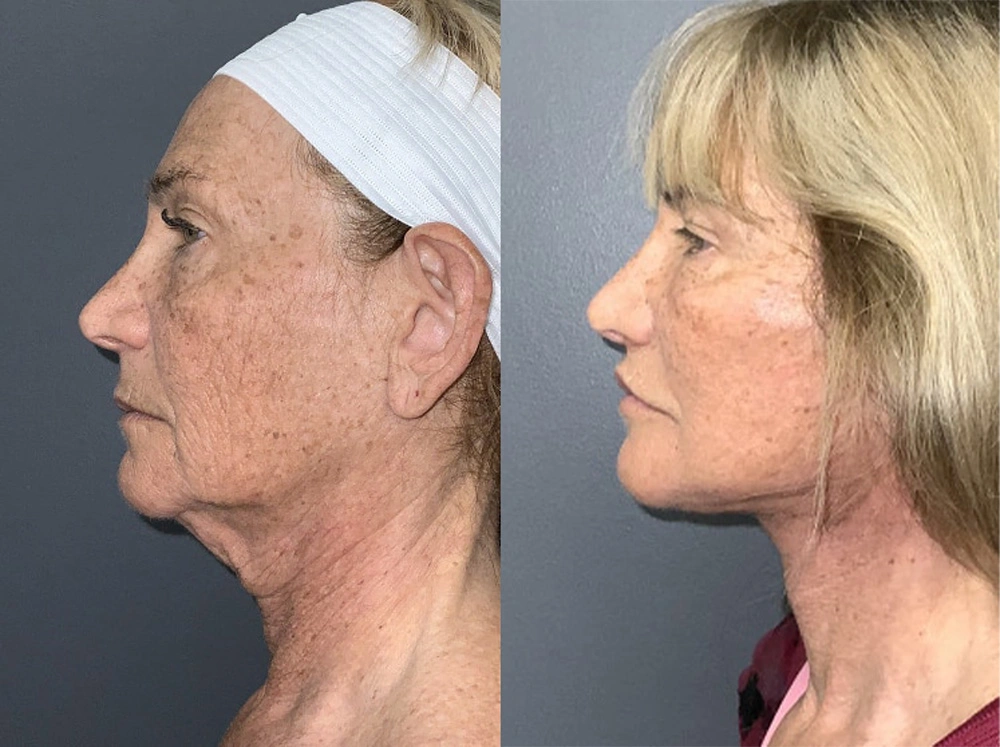 Real Patient Results in Newport Beach, CA. Preformed by Semira Bayait, MD, FACS.