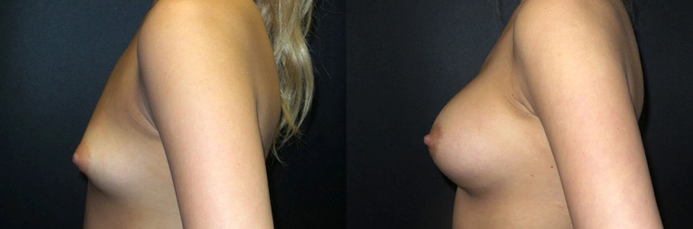 Real Patient Results in Newport Beach, CA. Preformed by Semira Bayait, MD, FACS.