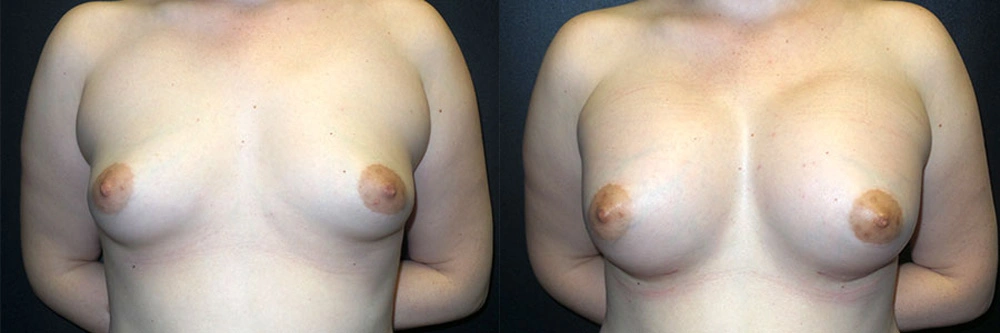 Real Patient Results in Newport Beach, CA. Preformed by Semira Bayait, MD, FACS.