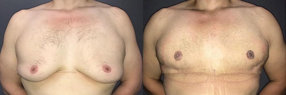 Real Patient Results in Newport Beach, CA. Preformed by Semira Bayait, MD, FACS.