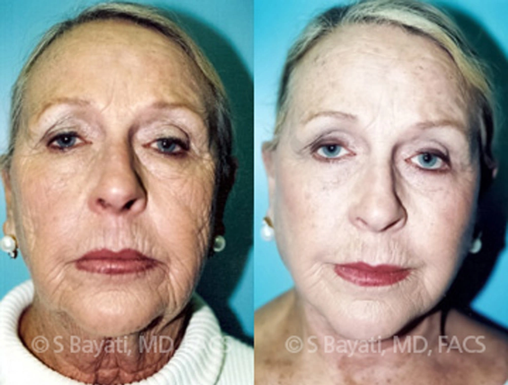 Real Patient Results in Newport Beach, CA. Preformed by Semira Bayait, MD, FACS.
