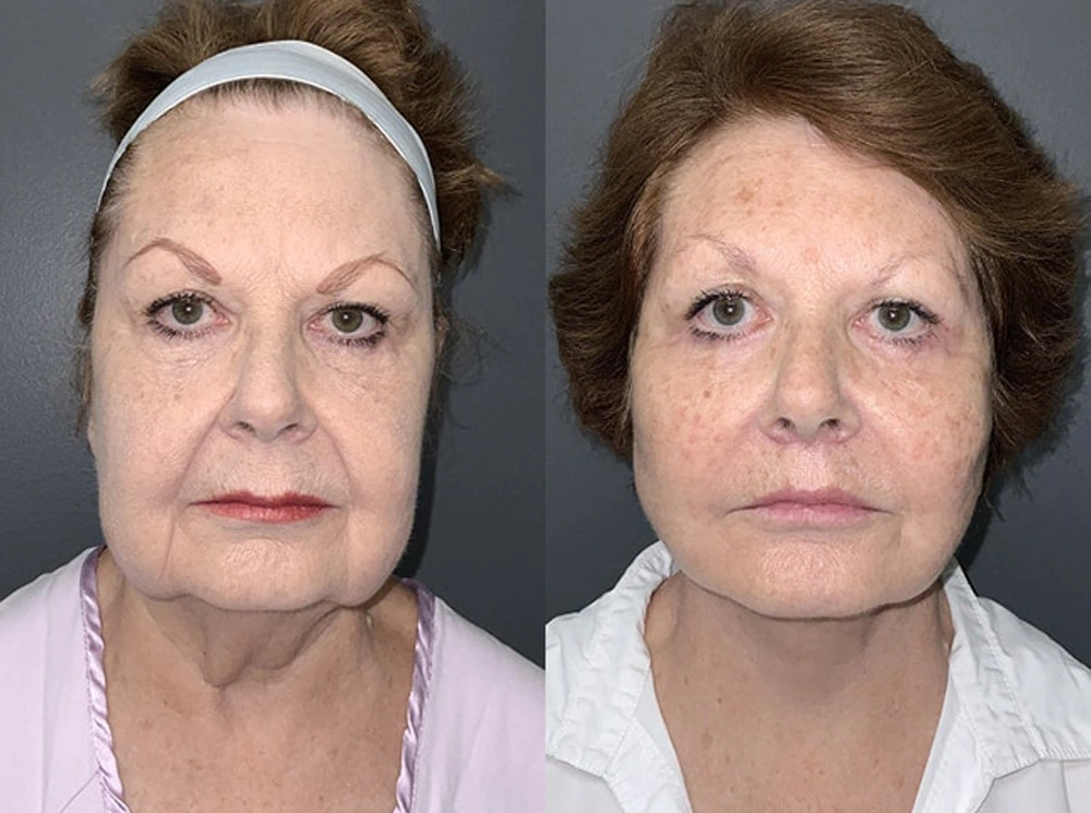 Real Patient Results in Newport Beach, CA. Preformed by Semira Bayait, MD, FACS.