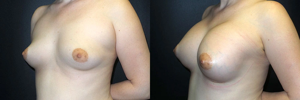 Real Patient Results in Newport Beach, CA. Preformed by Semira Bayait, MD, FACS.