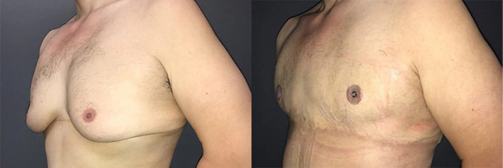 Real Patient Results in Newport Beach, CA. Preformed by Semira Bayait, MD, FACS.