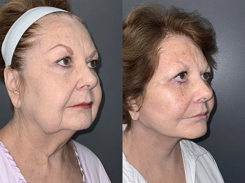 Real Patient Results in Newport Beach, CA. Preformed by Semira Bayait, MD, FACS.