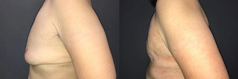 Real Patient Results in Newport Beach, CA. Preformed by Semira Bayait, MD, FACS.